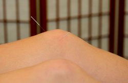 Acupuncture for arthritis: treatment of osteoarthritis of the knees