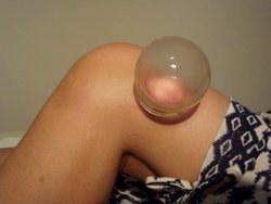 Cupping therapy: treatment of osteoarthritis of the knee.