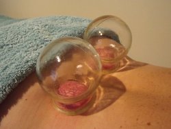 Cupping therapy: treatment of lower back pain.
