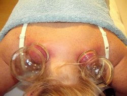 Cupping therapy: treatment of neck and shoulder pain.