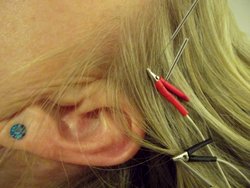 Scalp acupuncture reduces tinnitus intensity by half.