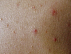 Acupuncture can help with acne.