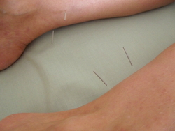 Acupuncture for Achilles inflammation.