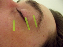 Acupuncture for Bell's palsy.