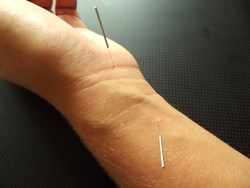 Acupuncture at points Daling and Neiguan which were used in this research: acupuncture and electroacupuncture are both helpful for carpal tunnel syndrome.