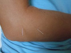 Acupuncture treatment for a frozen shoulder.
