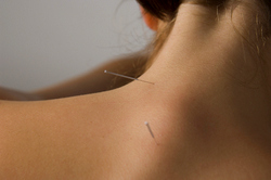 Acupuncture works for fibromyalgia.