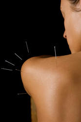 Acupuncture treatment for a frozen shoulder.