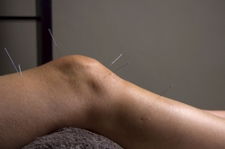 How acupuncture might help chronic pain