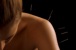 Acupuncture treatment for neck and shoulder pain.