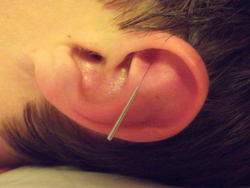Ear acupuncture for pain relief.