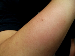 Acupuncture for itching: allergy testing of the skin of the forearm.