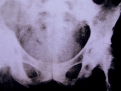Osteoporosis in men: X-ray showing osteoporosis of the pelvis.