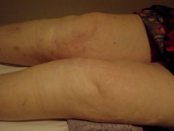 Acupuncture treatment of knee osteoarthritis.