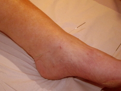 Acupuncture for heel pain.
