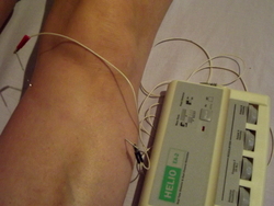 Electroacupuncture for relapsing-remitting multiple sclerosis: a tiny electrical current is run between two needles.