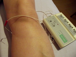 Acupuncture for osteoarthritis of the knee: electroacupuncture is applied, whereby a tiny electrical current is run between two needles.