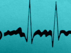 Acupuncture for cardiac arrhythmias.