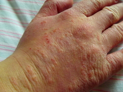 Acupuncture can help allergic itching in atopic eczema.